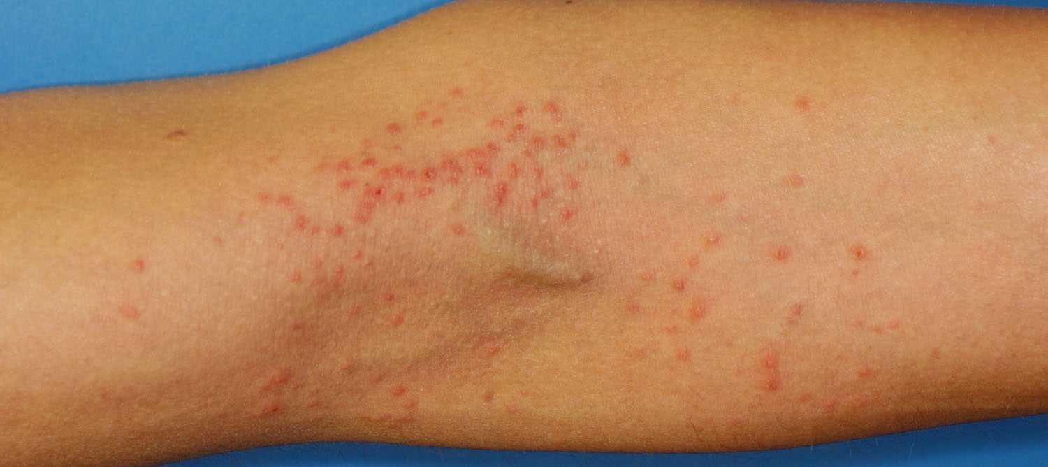 What Causes Skin Rashes Treatment