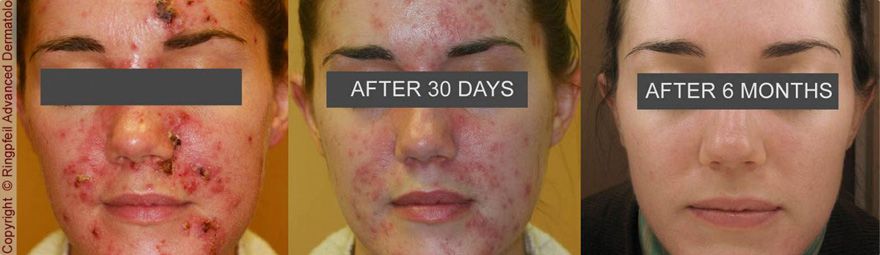 Before and After photos of Acne Treatment Process in Ringpfeil Advanced Dermatology