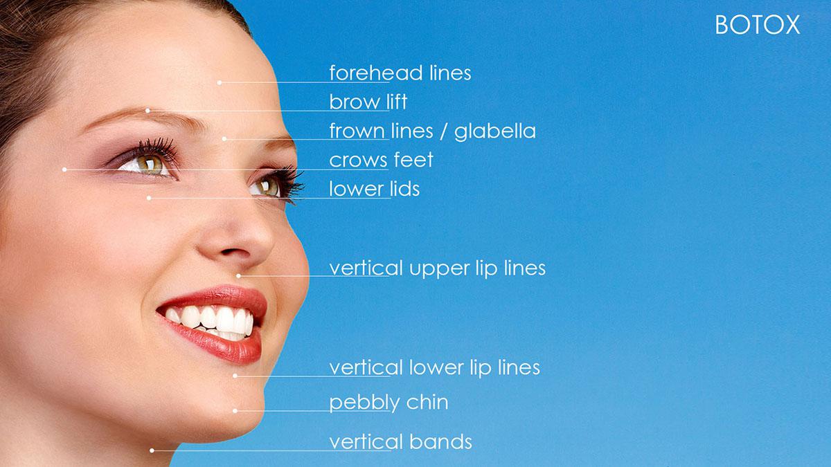 Botox hotspots for shaping of facial features, forehead lines, brow lift, frown lines/glabella, crows feet, lower lids, vertical upper lip lines, vertical lower lip lines, pebbly chin, vertical bands