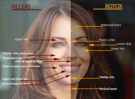 Botox VS Fillers, patient face zones