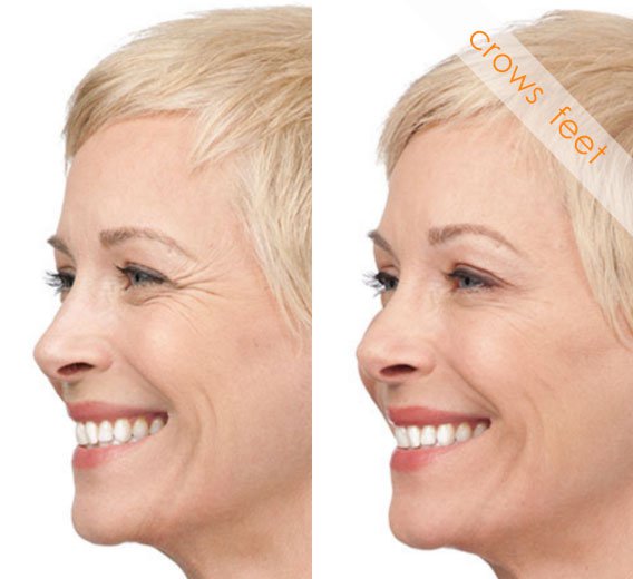 Before and After Crowsfeet Treatment, smiling female face, left side view