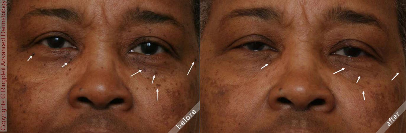 Before and After Dermatosis Treatment, patient face