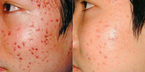 Before and After Acne treatment - Asian person, patient face, left side view