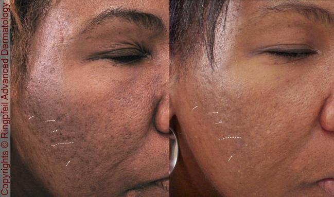 Before and After Scar treatment for African American patient, female face