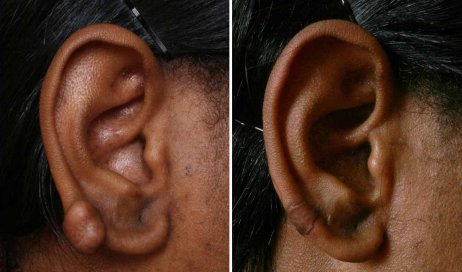 Before and After Scar treatment for African American patient, female ears, patient 2