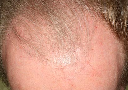 Hair Loss Treatment Androgenic Alopecia, male forehead, patient 2