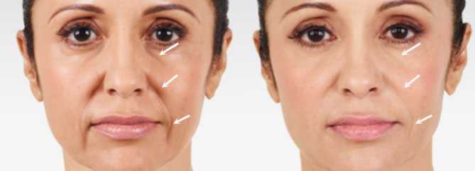Before and After Juvederm Treatment, female face