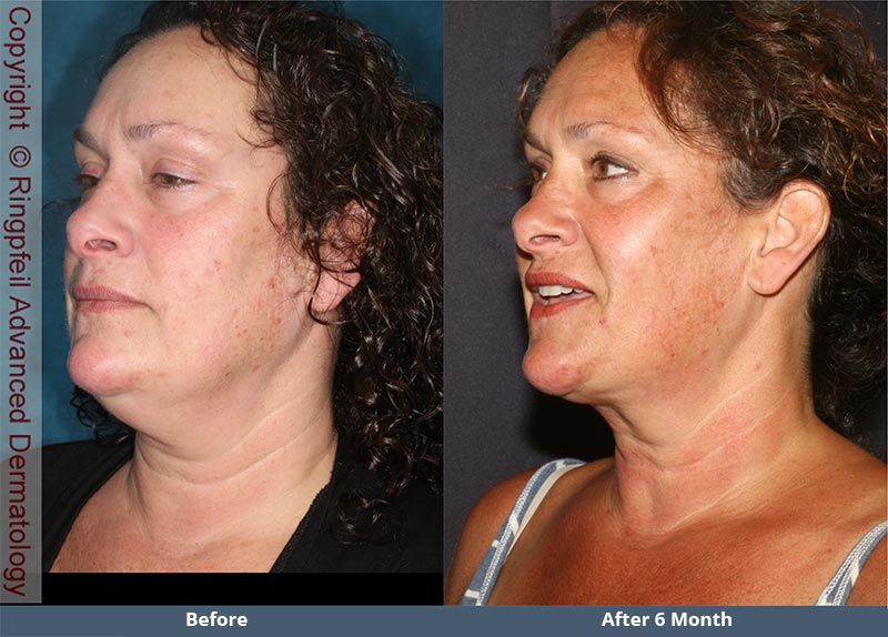 Before and  6 mounths After liposuction treatments, female face, patient 2 (left side, oblique view)