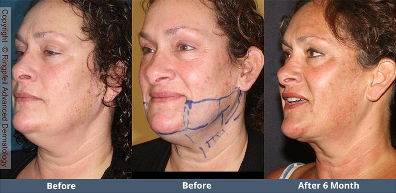 Before and  6 mounths After liposuction treatments, female face, patient 2 (oblique view)