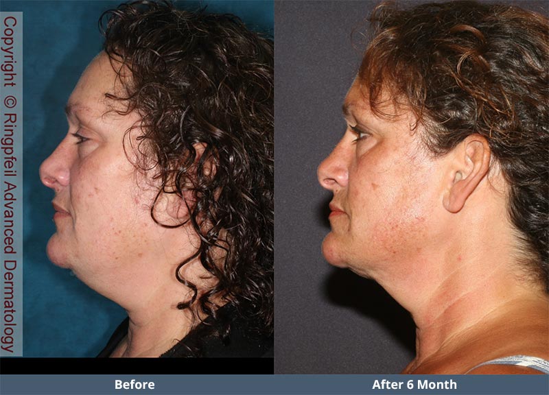 Before and  6 mounths After liposuction treatments, female face, patient 2