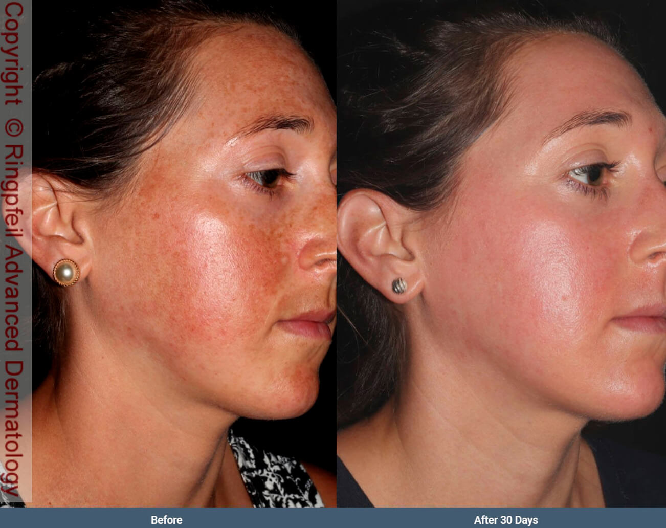Melasma- before and after treatment, female face, patient 2