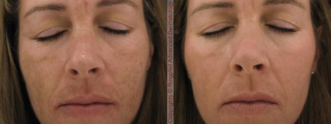 What is the best treatment for melasma?