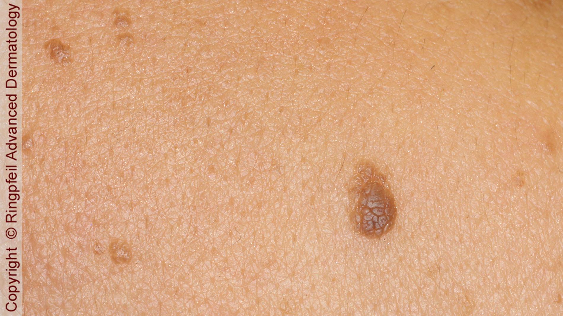 removal of atypical moles