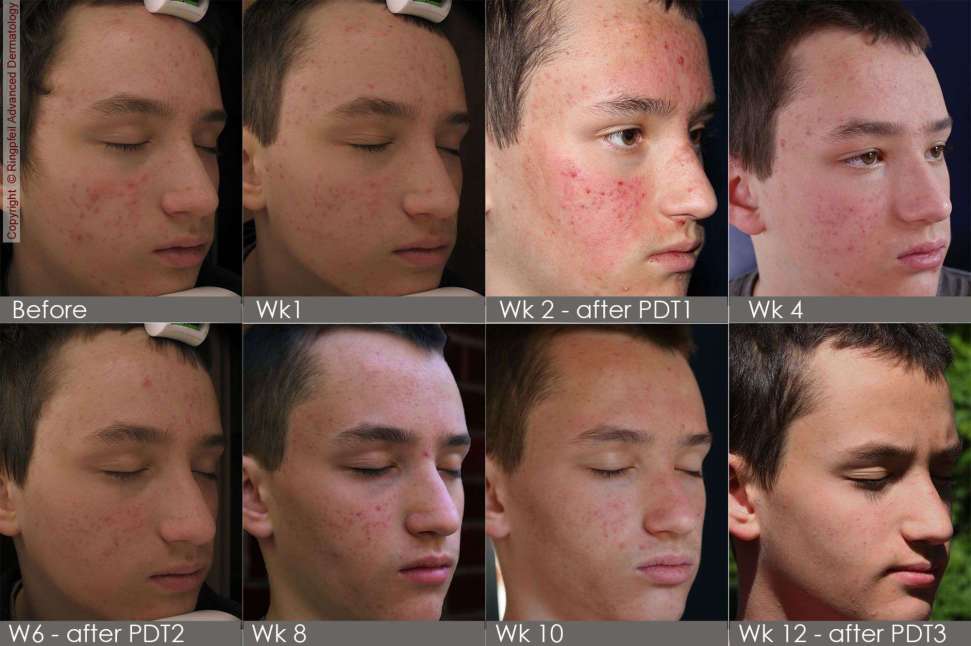 Male patient photodynamic therapy for acne treatment - before and after 12 weeks photos
