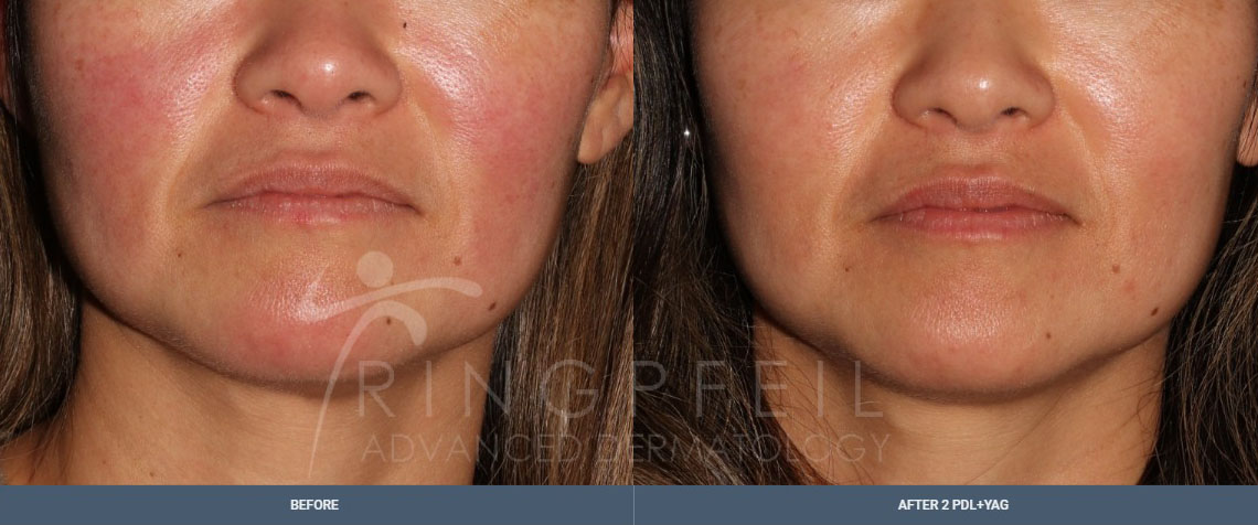 Rosacea - before and after two PDL and one YAG treatment, female patient, face, cheek