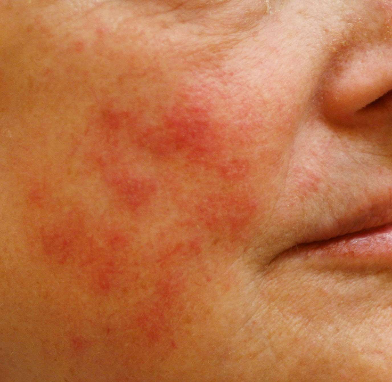 INFLAMMATORY ROSACEA