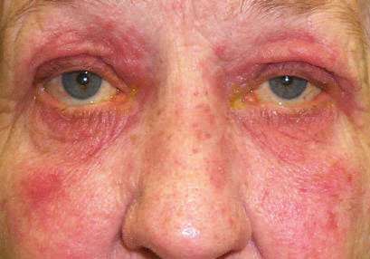 OCULAR ROSACEA