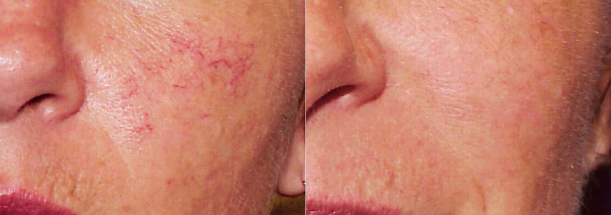 Rosacea - before and after treatment, patient face, cheek