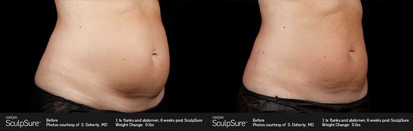 sculpsure before and after Treatment, male tummy tuck, patient 2