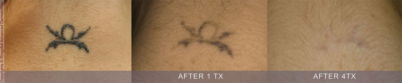 Before and After Treatment 4TX - Picosure Vs. QSwitch in Philadelphia - tattoo removal, patient 2