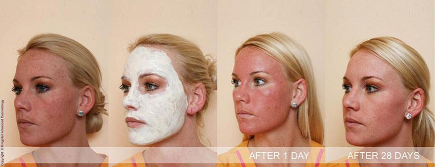 Before and After 28 days Chemical Peels treatment in Ringpfeil Advanced Dermatology - female face, oblique view