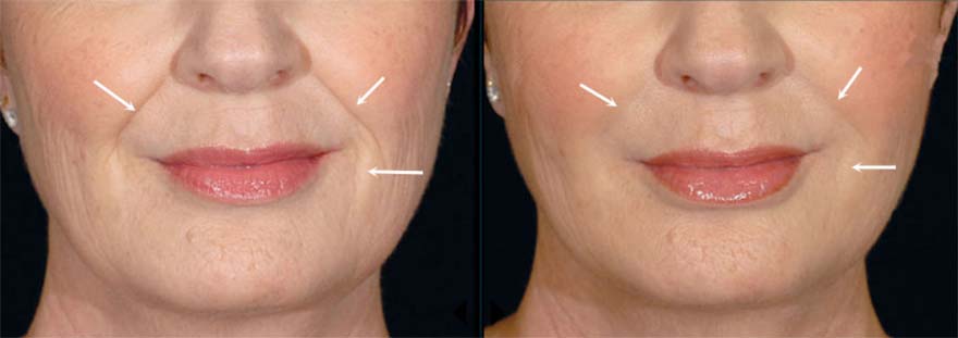 Before and After Restylane Treatment, female face (front view)
