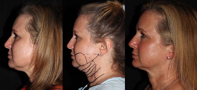 Before and  After liposuction treatments, female face, patient 3