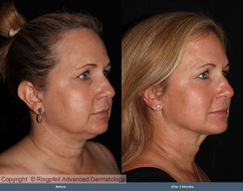 Before and  3 mounths After liposuction treatments, female face, patient 1