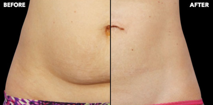 CoolSculpting - Before and After Treatment photos, female tummy tuck
