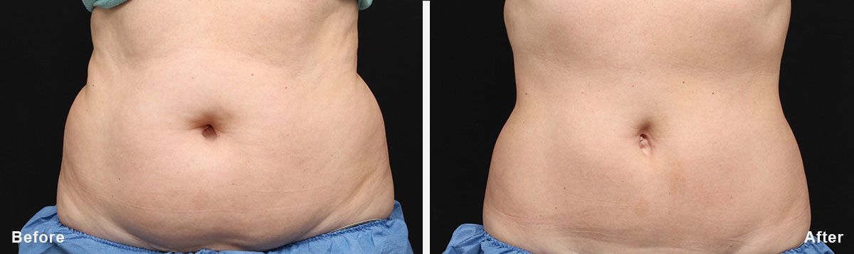 Coolsculpting - Before and After Treatment photos,  tummy tuck - female patint 2