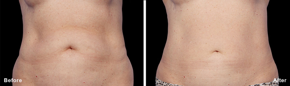 Coolsculpting - Before and After Treatment photos,  tummy tuck - female patint 4