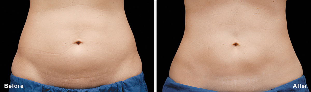 Coolsculpting - Before and After Treatment photos,  tummy tuck - female patint 5