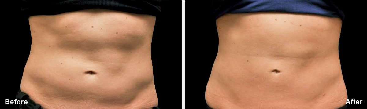 Coolsculpting - Before and After Treatment photos,  tummy tuck - female patint 6