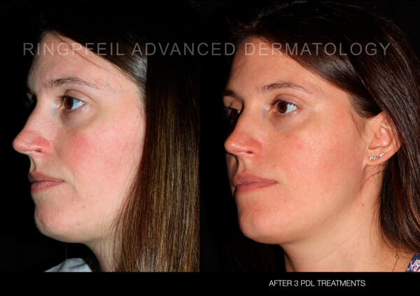 Rosacea - before and after treatment, female face, cheek -  patient 2