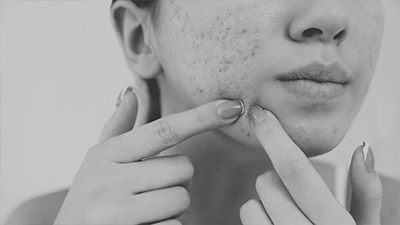 Acne Treatment