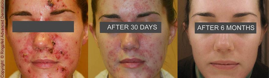 Photodynamic Therapy for Acne, Philadelphia | Pulse Dye ...