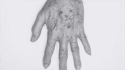 Brown Spots