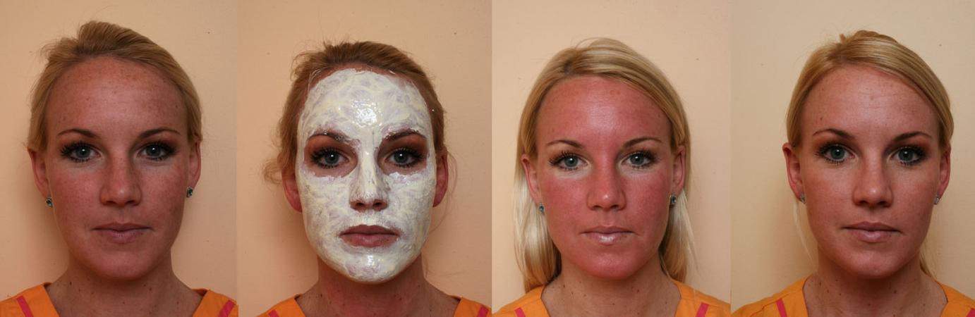 laser-treatment-for-brown-spots-on-face