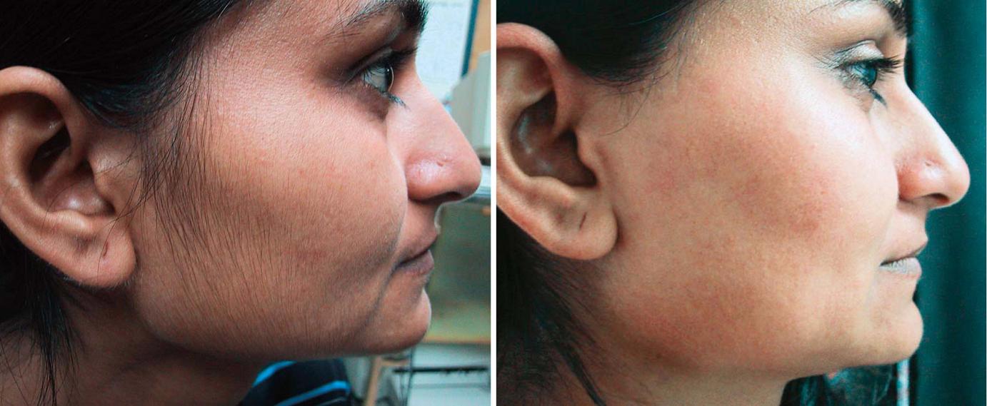 Hair removal for dark skin patients Before and After Treatment - female face, side view