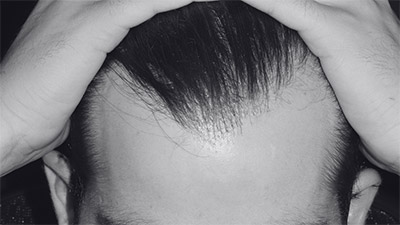 Hair Loss Treatment