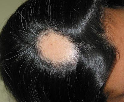 Hair Loss Treatment Alopecia Areata, male head