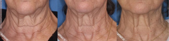 Before and After INFINI RF MICRONEEDLING Treatment, NYC in Ringpfeil Advanced Dermatology - female neck