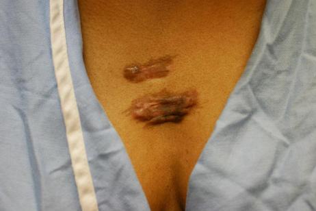 Keloids Chest, female - decollete area