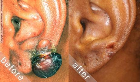 Before and After Scar treatment for African American patient, female ears, patient 3