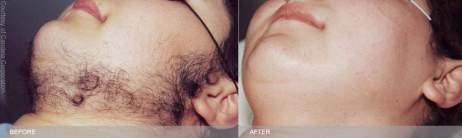 Laser Hair Removal for Facial Hair Before and After Treatment, male neck