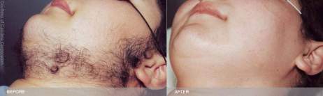 Facial Hair Removal Philadelphia - For Women and Men - Main Line, PA