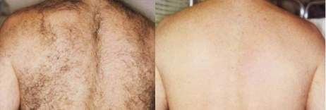 Laser Hair Removal - Men