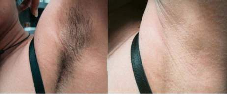Laser Hair Removal for Facial Hair Before and After Treatment, patient armpits