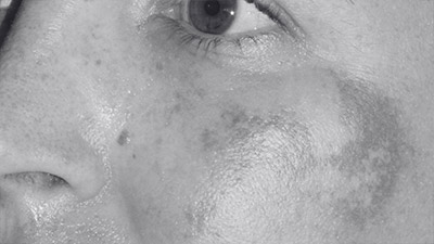 Melasma Treatment