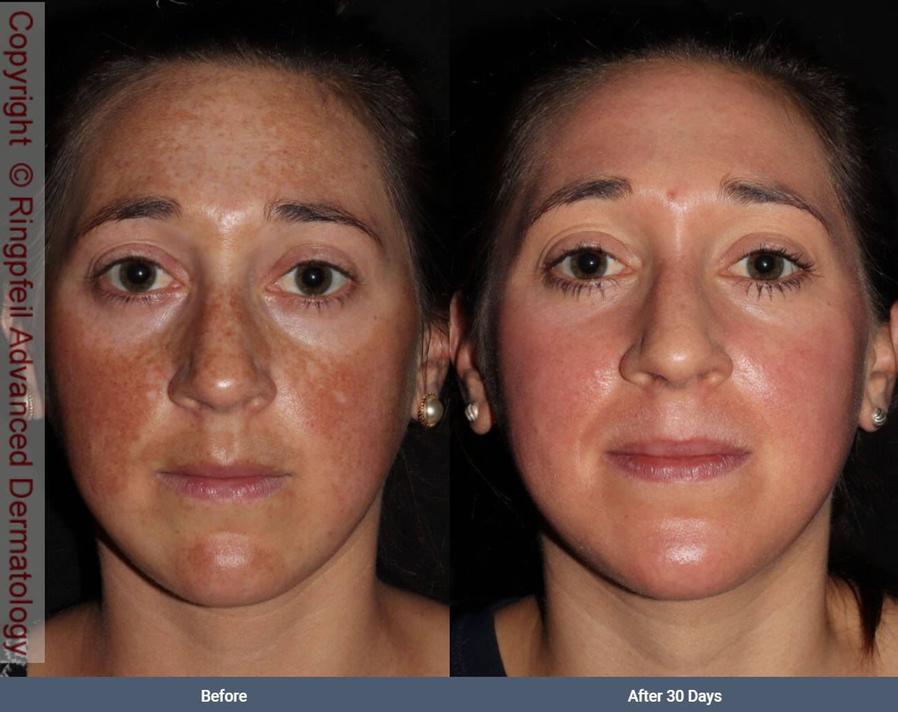 Melasma- before and after treatment, female face, patient 4
